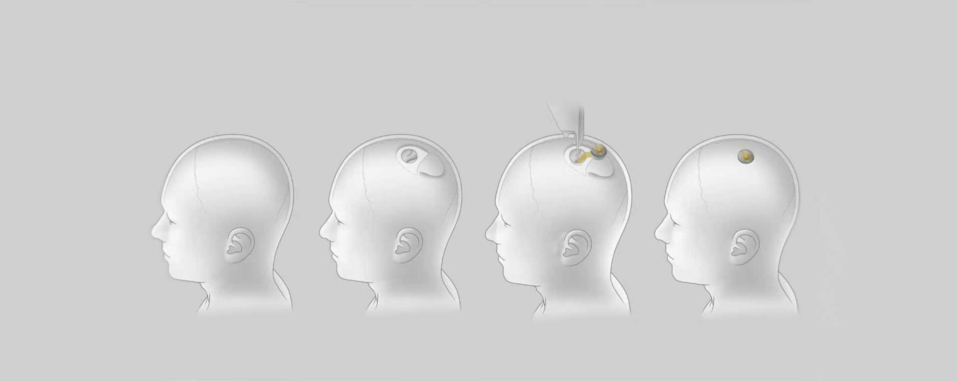 Neuralink импланти свињи